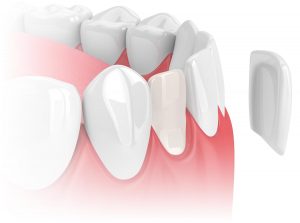dental veneer