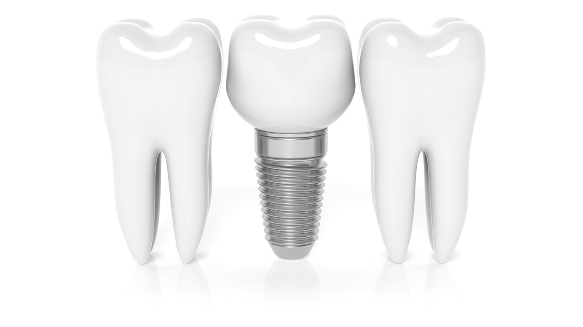 felton-dentistry-implant dental implant