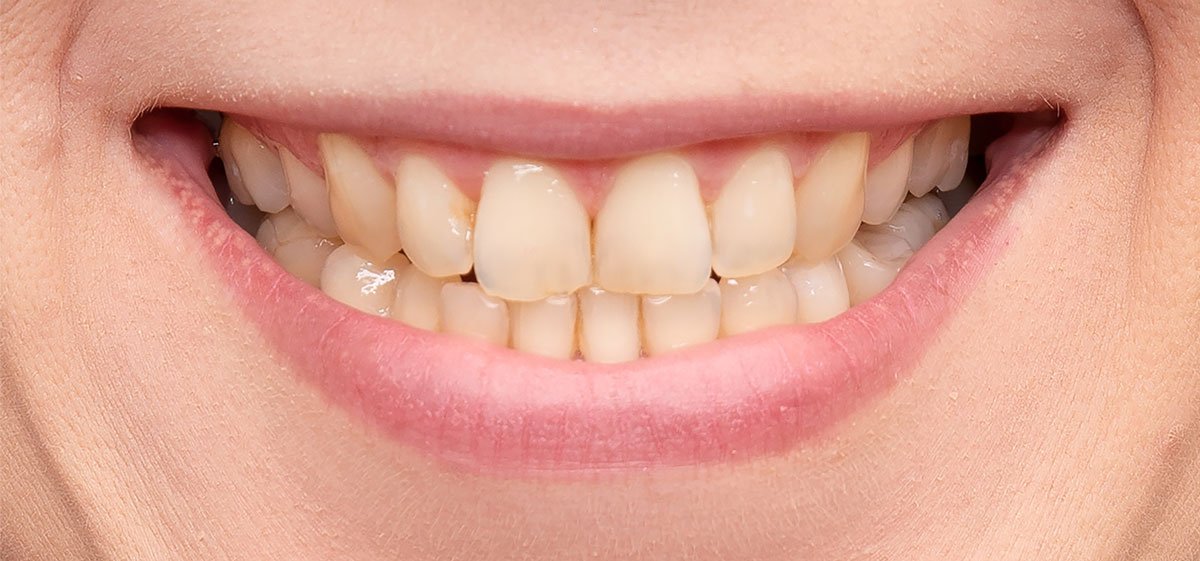 close up of yellow teeth